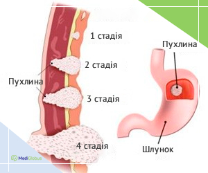 gastric_cancer_stages_ukr Стадії раку шлунка