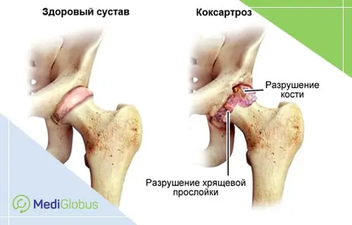 Иллюстрация сравнивает здоровый тазобедренный сустав и сустав, пораженный коксартрозом, с указанием разрушения хрящевой прослойки и костной ткани