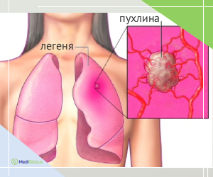 lungcancer_ukr Як виглядає рак легень