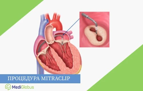 Mitrclip при недостаточности митрального клапана Анатомическая иллюстрация сердца с выделенной областью митрального клапана; показан процесс установки устройства MitraClip, соединяющего створки клапана; рядом увеличенное изображение инструмента, фиксирующего клапан