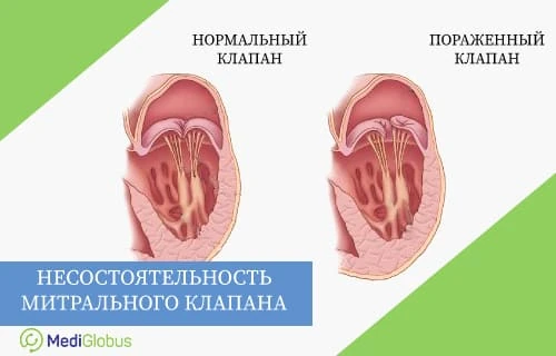 Сравнение здорового митрального клапана и клапана при митральной недостаточности