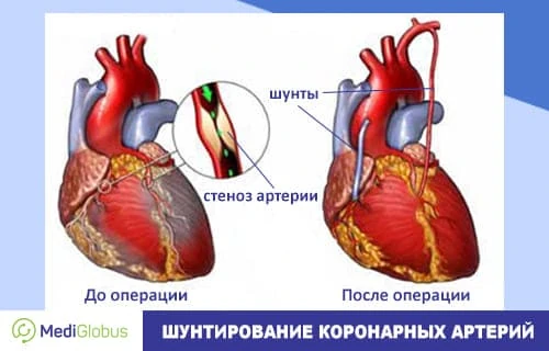 Сколько стоит и как проводится шунтирование коронарных артерий за границей Медицинская схема сердца до и после аортокоронарного шунтирования: слева показаны суженные артерии и стеноз, справа — установленные шунты, восстанавливающие кровоток.