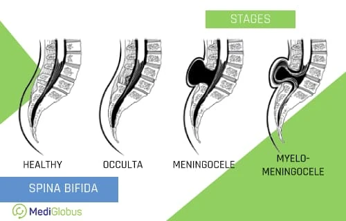 spina bifida stages