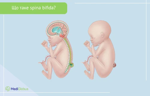 вроджена аномалія хребта — spina bifida ілюстрація новонародженого зі spina bifida, з вадою хребта та випинанням у поперековій ділянці