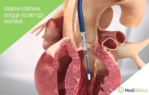3D-визуализация проведения процедуры TAVI/TAVR, видно катетер, введенный через сосуд в область аортального клапана