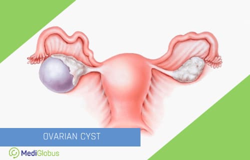 ovarian cyst treatment abroad