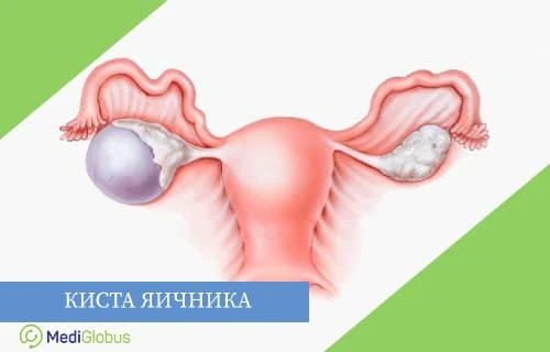 лечение кист яичника