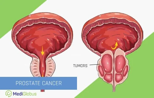 what is prostate cancer