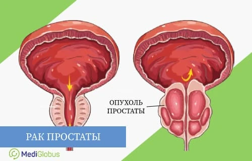 схематическое изображение предстательной железы: слева здоровая простата, справа простата с опухолью