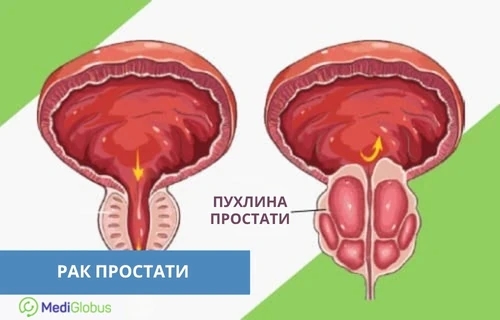схематичне зображення передміхурової залози: ліворуч — здорова простата, праворуч — простата з пухлиною