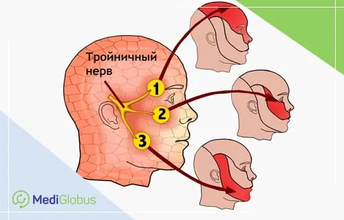 невралгия тройничного нерва схема тройничного нерва с тремя ветвями и зонами боли на лице