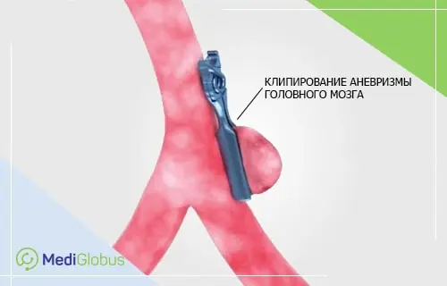 3D-изображение клипирования аневризмы