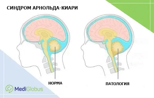 синдром Арнольда-Киари сравнение нормальной анатомии головного мозга и патологии при синдроме Арнольда-Киари