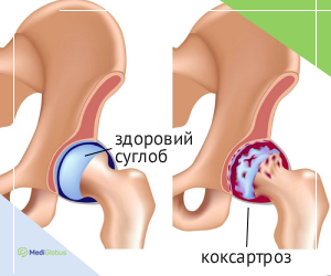 healthy_vs_coxarthrosis_joint_ukr Порівняння суглобу з коксартрозом зі здоровим