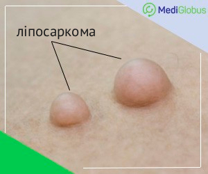 liposarcoma_skin_ukr Як виглядає ліпосаркома шкіри