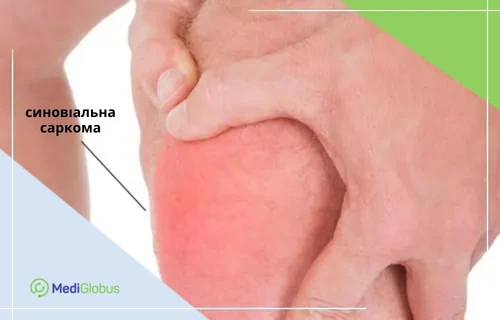 чоловік тримається за коліно з виділеною червоною ділянкою та вказівкою на синовіальну саркому