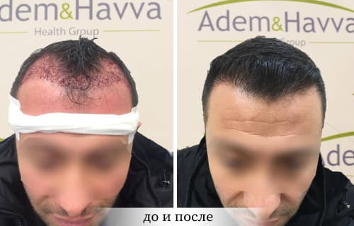 клиника адам и ева в стамбуле турция пересадка волос до и после