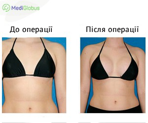 breast_augmentation_beforeafter_ukr Фото до після збільшення грудей в Туреччині