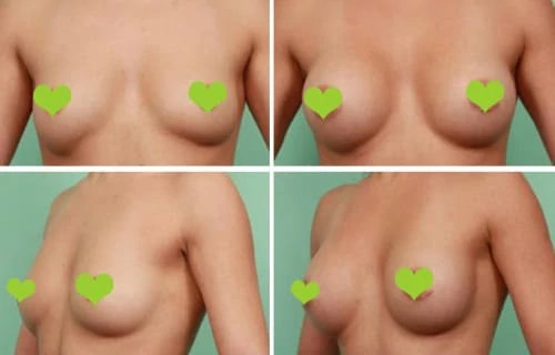 cosmed clinic breast augmentation before after