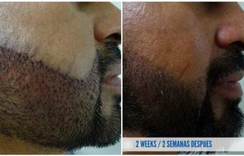 cosmed clinic hair transplant before after