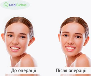 otoplasty_beforeafter_ukr Фото до після отопластики