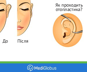 otoplasty_surgery_ukr Як проводиться отопластика?