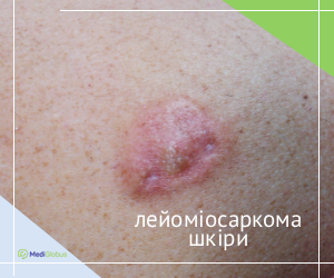 skin_leyomyosarcoma_ukr Як виглядає лейоміосаркома шкіри