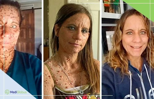 Нейрофиброматоз у взрослых Три фотографии женщины с множественными кожными образованиями на лице и теле до и после лечения