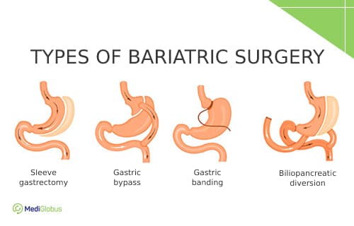 Bariatric surgery