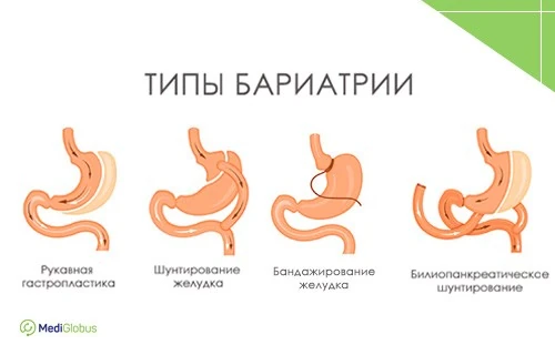 Методы бариатрической хирургии схематические изображения типов бариатрических операций: рукавная гастропластика, шунтирование желудка, бандажирование, билиопанкреатическое шунтирование
