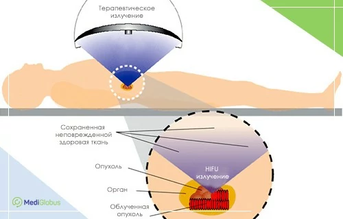 Как работает HIFU Медицинская схема проведения HIFU‑терапии: человек лежит на столе, над областью опухоли расположен аппарат, направляющий терапевтическое излучение; в увеличенном фрагменте показано, как HIFU‑лучи воздействуют на опухоль, сохраняя здоровые ткани.