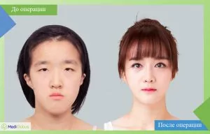 Blepharoplasty in Korean clinic ID Hospital before and after photo