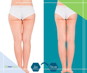 beforeafter_liposuction_korea_ukr фото до та після ліпосакції ніг в Південній Кореї
