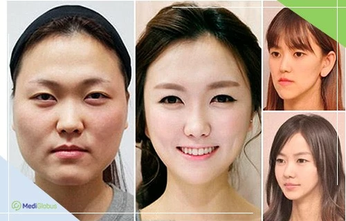Clinics, prices and reviews of blepharoplasty in Korea
