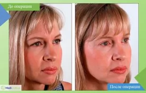 Before and after photo of eyelid surgery in Turkey