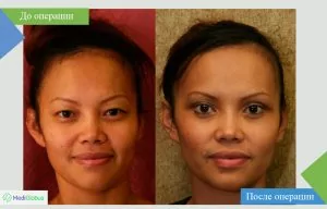 Before and after photo of eyelid surgery in Turkey