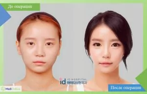 Before and after photos of blepharoplasty at ID Hospital