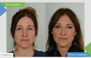 Upper eyelid correction in Israel before and after photo