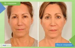 Eyelid surgery in Israel before and after photo