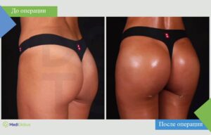 Подтяжка ягодиц фото до после Бюлент Джихантимур
