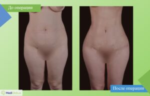 Липосакция фото до после Бюлент Джихантимур