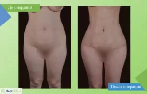 Липосакция - работа Бюлента Джихантимура Липосакция фото до после Бюлент Джихантимур