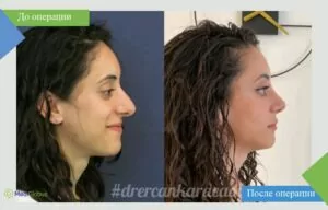 Ринопластика - работа доктора Эрджана Караджаоглу Эрджан Караджаоглу фото до после ринопластика