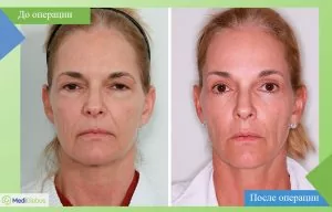 Eyelid surgery before and after photo in Israel
