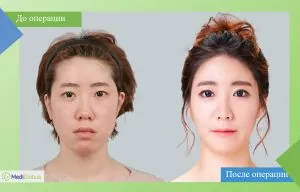 Circular blepharoplasty before and after photo