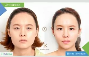 Eyelid surgery at JK Hospital before and after photo