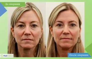 Before and after photos of eyelid surgery in Turkey, reviews of blepharoplasty in Turkey