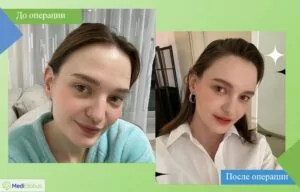 Липографтинг - работа доктора Джу Квона Доктор Джу Квон - фото до после липографтинг