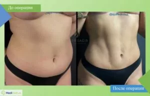 Липосакция - работа доктора Омера Саыра Омер Саыр фото до после липосакция