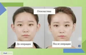 Фото до и после отопластики в Корее фото до и после отопластики
